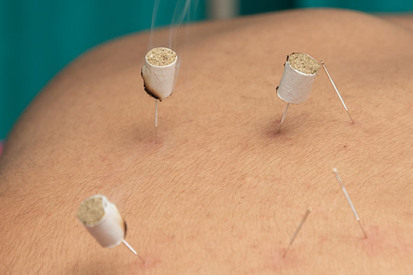 Acupuncture points being targeted in Patanjali therapy